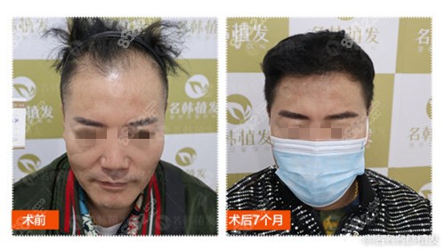 济南名韩际线种植效果图