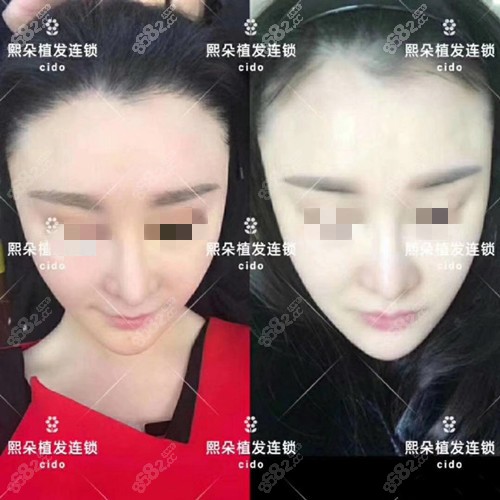 济南熙朵发际线种植效果图