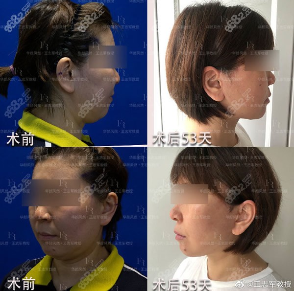 西安国 际医学<!--<i data=20240705-sp></i>-->王志军大拉皮手术50天效果