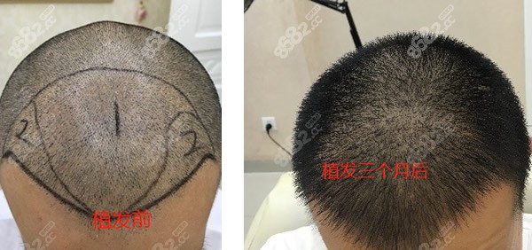西安熙朵额头植发+发际线调整3个月前后对比照片