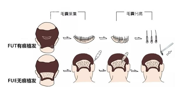fut植发和fue植发的区别