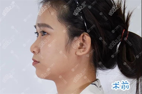 广州曙光双侧耳软骨隆鼻