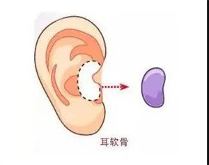 广州曙光双侧耳软骨隆鼻