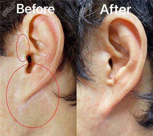 重庆光博士祛除拉皮耳前疤痕对比