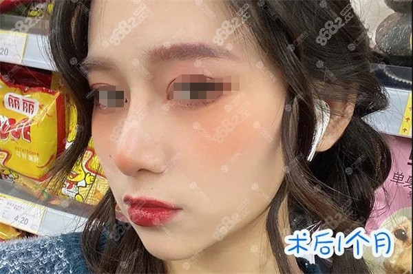 广州曙光双侧耳软骨隆鼻