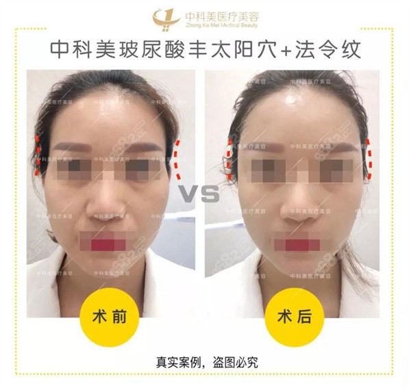 <!--<i data=20240705-sp></i>-->徐思思玻尿酸法令紋 <!--<i data=20240705-sp></i>-->徐思思玻尿酸法令紋