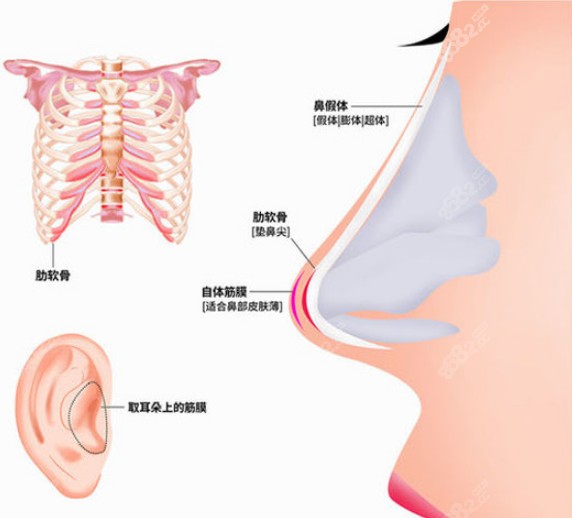 大连何栋良医生做肋软骨+假体+自体筋膜鼻综合