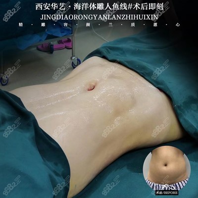 腰腹吸脂術(shù)前術(shù)后對(duì)比 腰腹吸脂術(shù)前術(shù)后對(duì)比