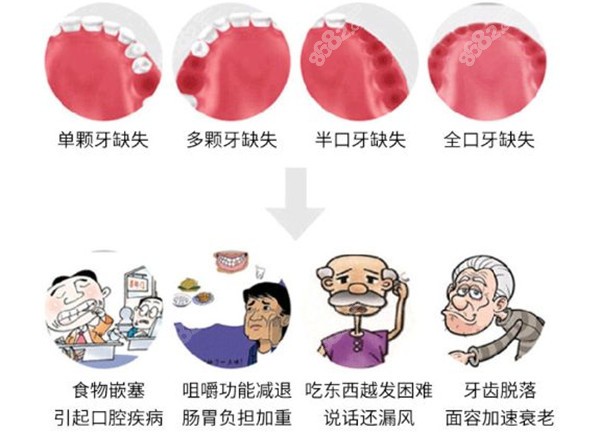 深圳格伦菲尔种植牙