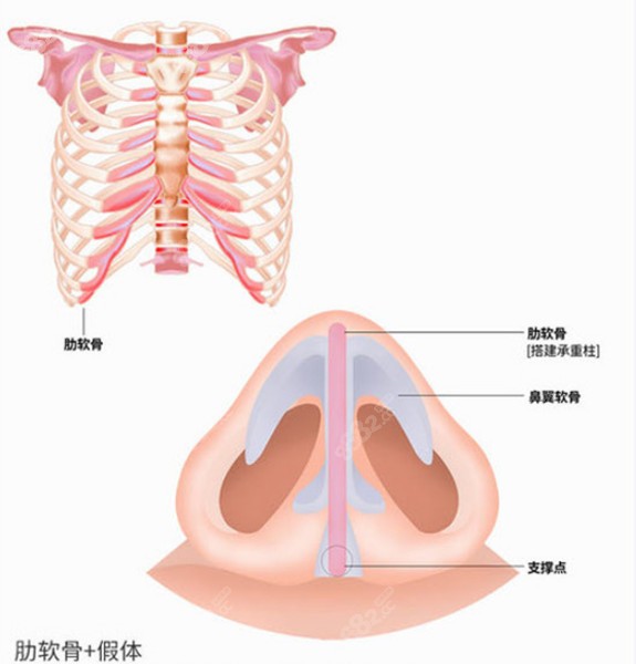 大连何栋良医生做肋软骨+假体鼻综合过程