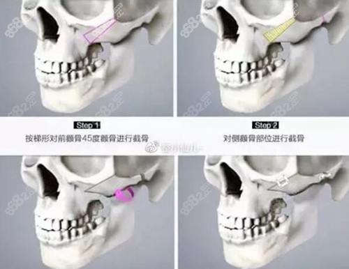 徐威强做颧骨用的是全折断固定