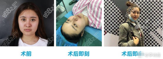 從術(shù)前到術(shù)后即刻創(chuàng)可貼面部吸脂的效果