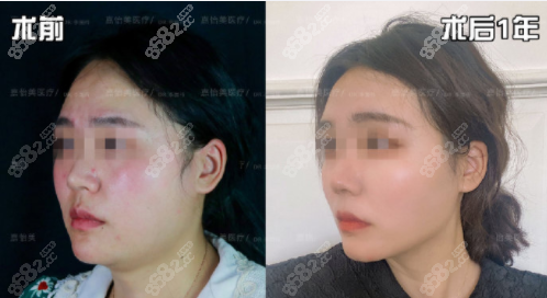 面部吸脂（下頜緣+雙下巴）術(shù)后一年對比