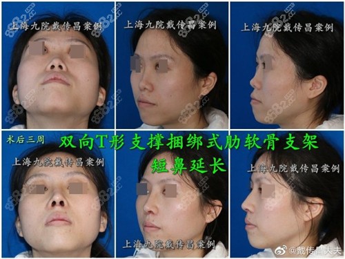 肋软骨隆鼻效果图
