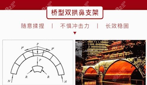 周医生会把鼻部支架做成拱形