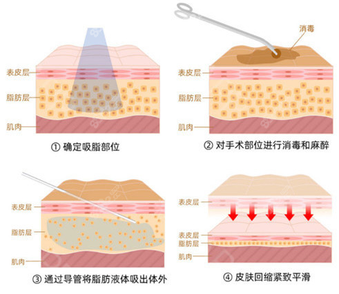 多维分层柔性吸脂过程图示