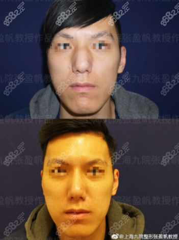 <!--<i data=20240705-sp></i>-->驼峰鼻矫正效果图