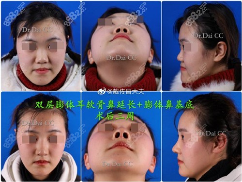 耳软骨隆鼻效果图
