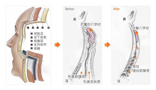 王志军医生拉皮手术技术优势