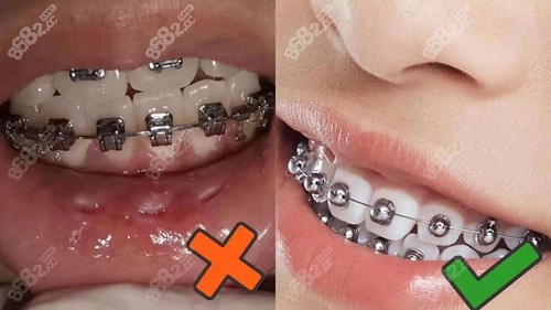 北京球形自锁托槽牙齿矫正价格