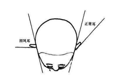 招風(fēng)耳樣子