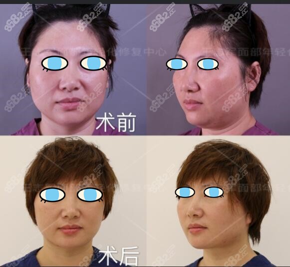 王志军做过的拉皮除皱效果图片
