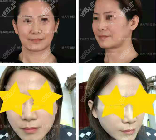 北京联合丽格拉皮手术对比照