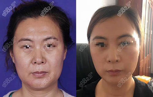北京加减美拉皮对比照