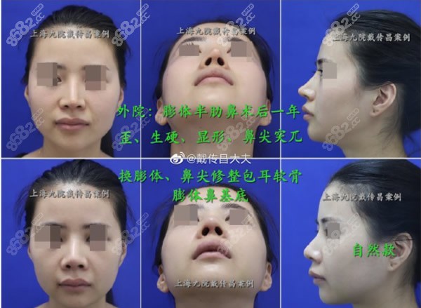 鼻修复风格和效果图片