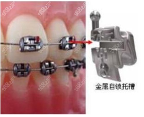 北京金属自锁托槽牙齿矫正价格