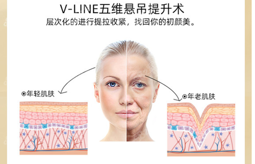 北京润美玉之光朱金成面部提升所用的五维悬吊术
