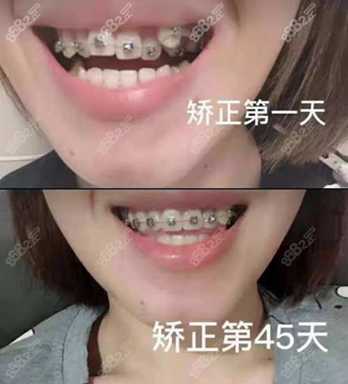 芜湖壹加壹口腔牙齿矫正对比照