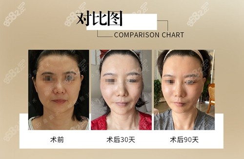 北京华韩柳民熙所做的3D童颜术面部提升对比效果图