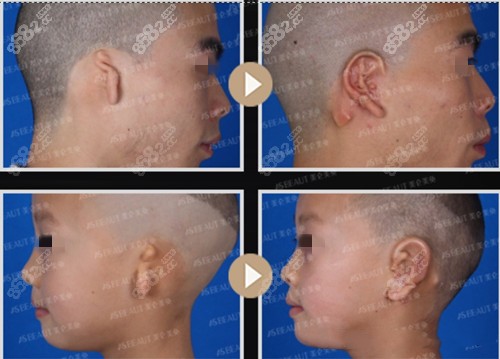 美仑美奂大力开展耳部整形项目,涵盖全耳再造,耳廓塑形,耳垂畸形矫正