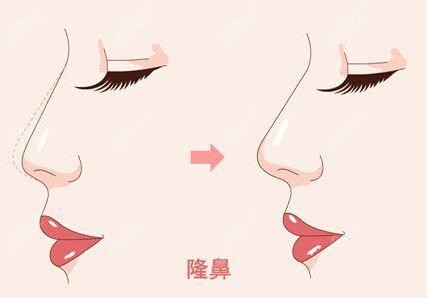 上海首尔丽格做隆鼻手术的优势介绍