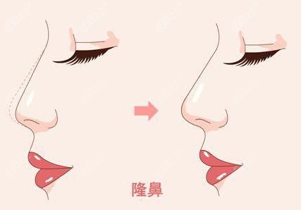 做隆鼻手术的优势介绍