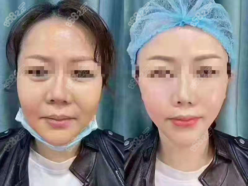 医疗美容医院拉皮手术对比照