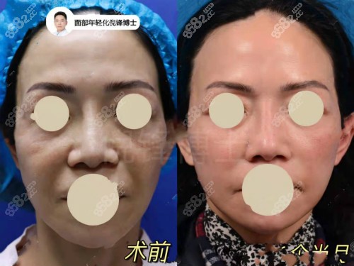 医疗美容拉皮手术对比照