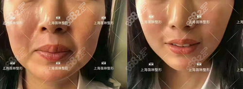 上海薇琳医疗美容医院拉皮手术对比照