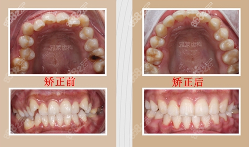 杭州雅莱口腔牙齿矫正前后对比图