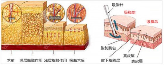 北京知音整形李文波医生做大腿抽脂手术过程