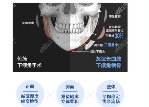 <!--<i data=20240705-sp></i>-->做下颌角截骨技术优势