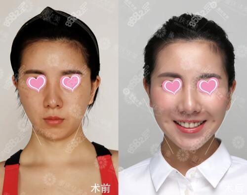 重庆华美陈凯自体脂肪全脸填充真人对比照