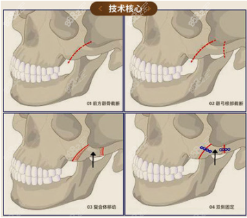 磨颧骨优势