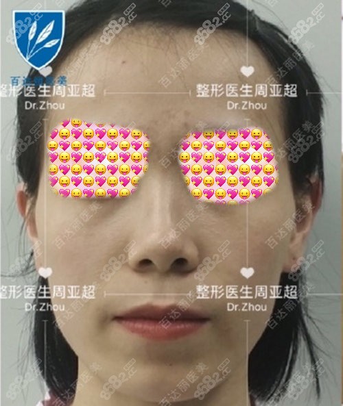 上海周亚超面部脂肪填充术前