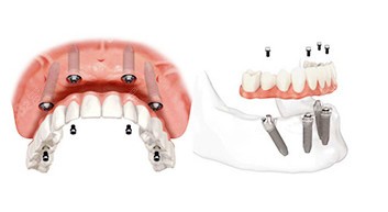 all-on-4全口种植牙