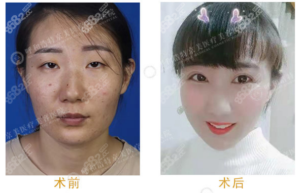 双眼皮实例
