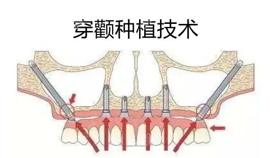 穿颧种植技术