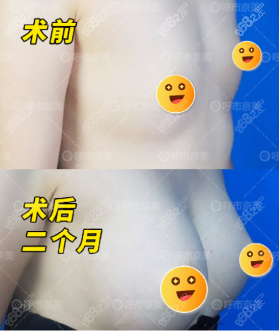 脂肪丰胸实例