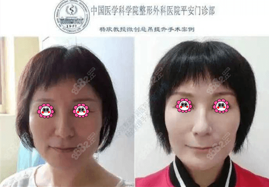 北京八大<!--<i data=20240705-sp></i>-->做的微创悬吊术除皱效果